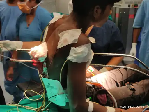 सीने के आर-पार हुए 40 फीट के सरिए : 5 घंटे चले ऑपरेशन के बाद बची जान 1 12333 1635671185