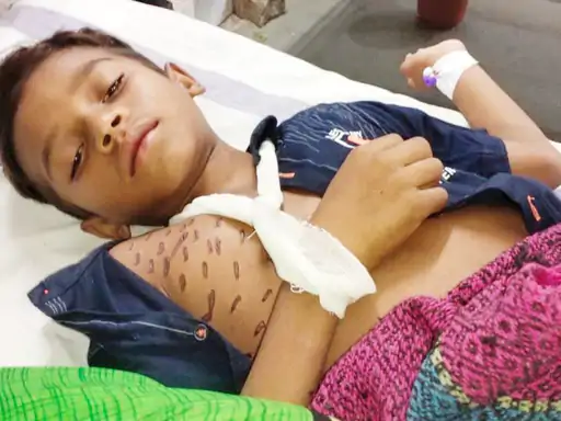 अंधविश्वासी दादी ने पोते को गर्म सरिए से दागा:कंधे-पसलियों में हुआ था फ्रैक्चर, बच्चे को दागने से हुआ इंफेक्शन 1 33 1635003885