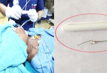 JABALPUR NEWS- मेडिकल के ईएनटी डॉक्टरों बचाई बच्ची की जान : 6 साल की बच्ची ने निगली एलईडी पेन लाइट, बोलना बंद किया तो मेडिकल लेकर पहुंचे परिजन 11 13 10