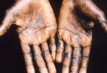 who to convene emergency meeting over monkeypox outbreak 1653048479