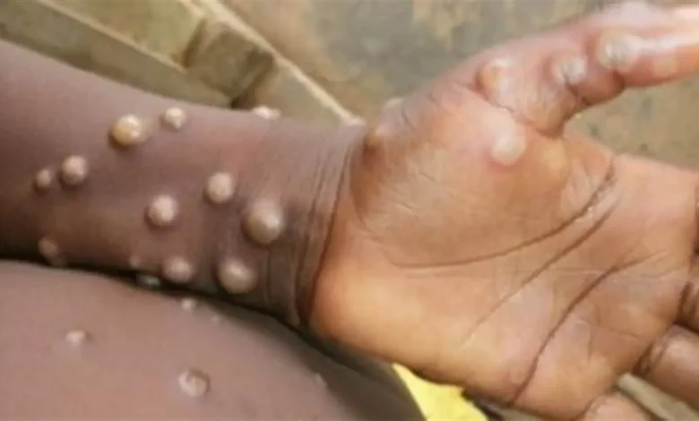 दिल्ली में मंकीपॉक्स का 5वां केस मिला, देश में अब तक 10 मामले 1 monkeypox 1