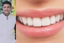 अच्छी मुस्कान के लिए दांतों की समस्या को न करें नजरअंदाज- डॉ धवल 10 add 10