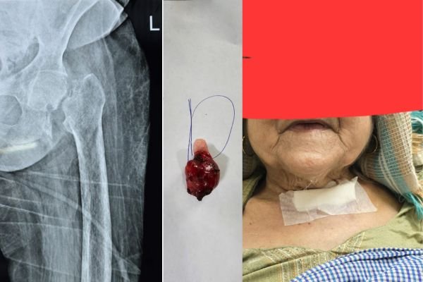 A strange case came to the medical hospital: मेडिकल अस्पताल में आया अजीबो-गरीब मामलाः 70 साल की बुजुर्ग महिला को गले में ट्यूमर, टूट गई पैर की हड्डी 1 Add a heading 79
