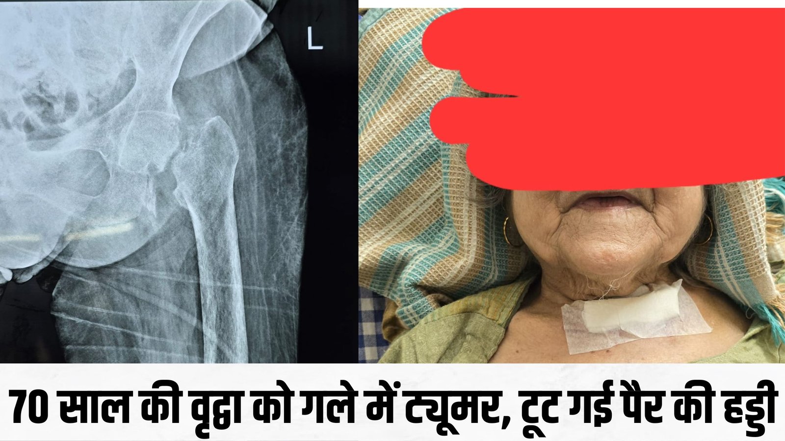 A strange case came to the medical hospital: मेडिकल अस्पताल में आया अजीबो-गरीब मामलाः 70 साल की बुजुर्ग महिला को गले में ट्यूमर, टूट गई पैर की हड्डी 2 ग्लो एंड गार्ड ठेका कंपनी के कर्मचारी 2