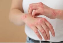 पुरुषों में सोरायसिस होने की संभावना महिलाओं की तुलना में दोगुनी होती है, जानें इसके लक्षण 10 एयर इंडिया का विमान हादसे का शिकार होते होते बचा 2