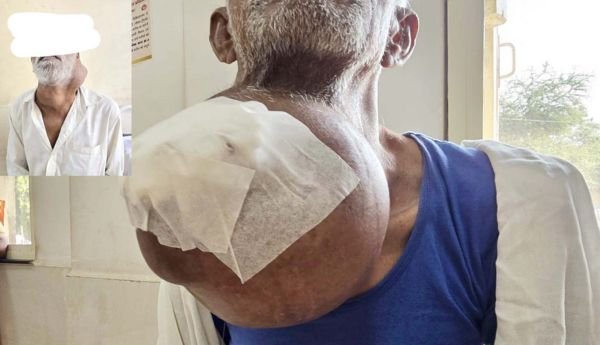 NSCB medical college JABALPUR : 75 साल के वृद्व को दो कैंसर, 70 साल का दूसरा वृद्व तीन साल 4 किलो का ट्यूमर लेकर घूम रहा था 1 इजरायल की बमबारी से 44