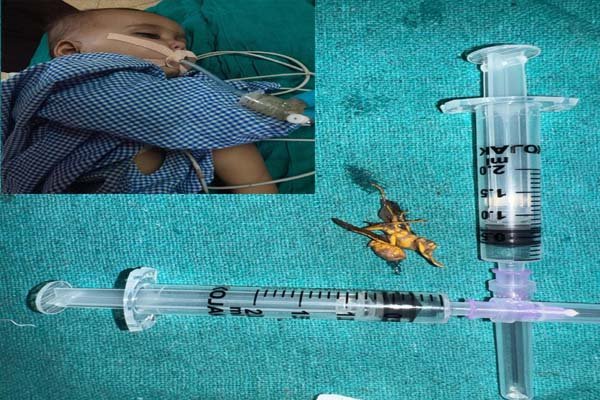 6 माह की बच्ची के गले में फंसा कीड़ा, डेढ़ साल के बच्चे ने निगल लिया चिकिन का टुकड़ा, मेडिकल में सफल ऑपरेशन 1 WhatsApp Image 2025 04 14 at 21.17