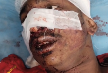 पुराने विवाद को लेकर युवक पर चाकू से हमला 10 arera