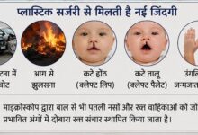 सिर्फ खूबसूरती नहीं, जिंदगी भी संवार रही प्लास्टिक सर्जरी हमीदिया में 80% से अधिक री-कंस्ट्रक्टिव ऑपरेशन, महिलाओं में बढ़ी ब्रेस्ट ऑगमेंटेशन की मांग 18 IMG 20260731 WA00051