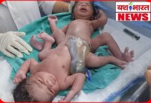 कुदरत का अद्भुत करिश्मा: जिला अस्पताल में जन्मा अनोखा बच्चा—एक शरीर, दो सिर! 4 InCollage 20260725 080655713