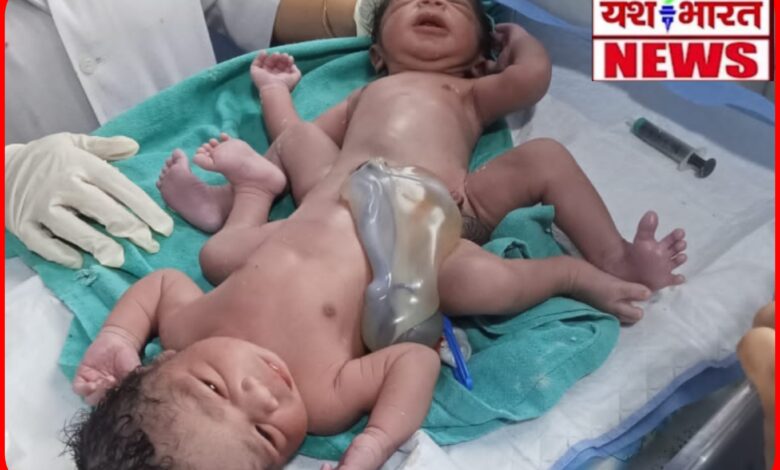 कुदरत का अद्भुत करिश्मा: जिला अस्पताल में जन्मा अनोखा बच्चा—एक शरीर, दो सिर! 1 InCollage 20260725 080655713