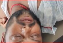 जंगल में युवक पर कुल्हाड़ी से हमला, पंजा काटकर किया अलग; कटे पंजे को पॉलिथीन में लेकर अस्पताल पहुंचा पीड़ित 2 InCollage 20260905 100129867