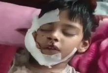 घर में घुसकर 8 साल के बच्चे का नोंचा चेहरा, 15 लोगों को बनाया शिकार 2 20261021131645 eMFB82iV