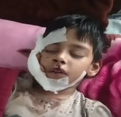 घर में घुसकर 8 साल के बच्चे का नोंचा चेहरा, 15 लोगों को बनाया शिकार 1 20261021131645 eMFB82iV